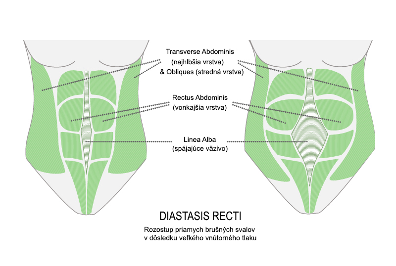 diastasis_recti